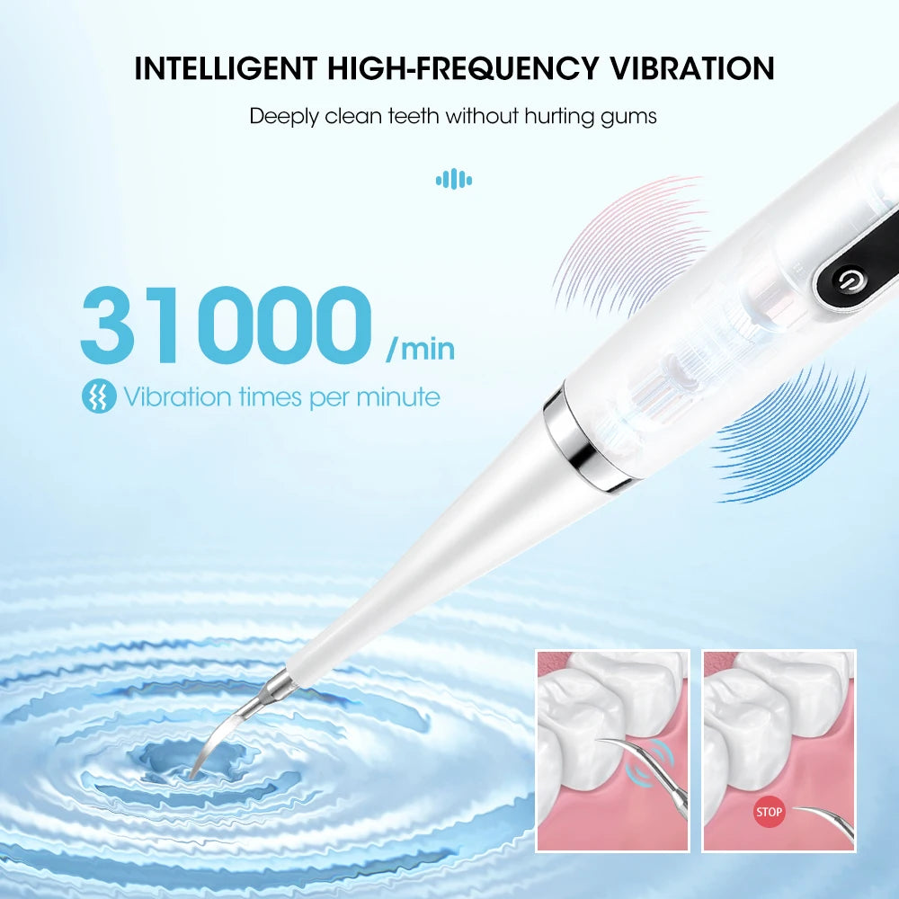 1 A Dental Calculus Removal